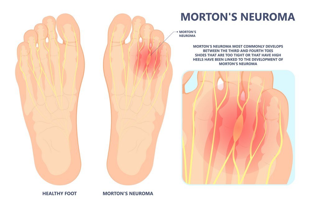 Morton Neuroma