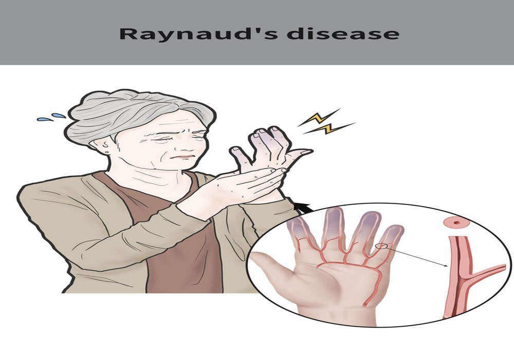 Raynaud’s disease