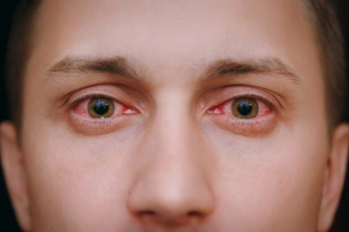 Symptoms of Dry Eyes