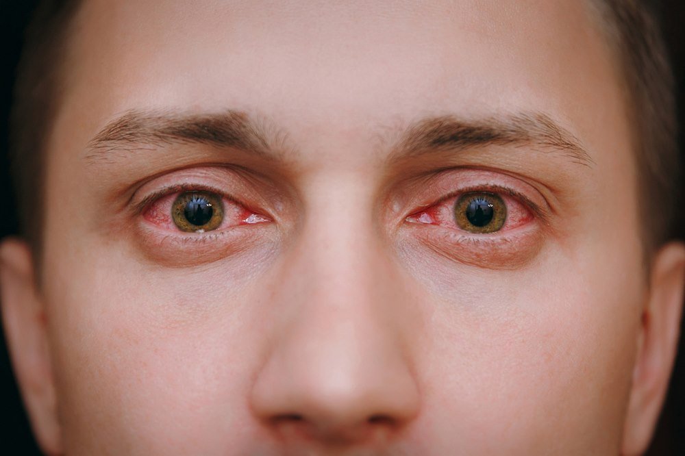 Symptoms of Dry Eyes