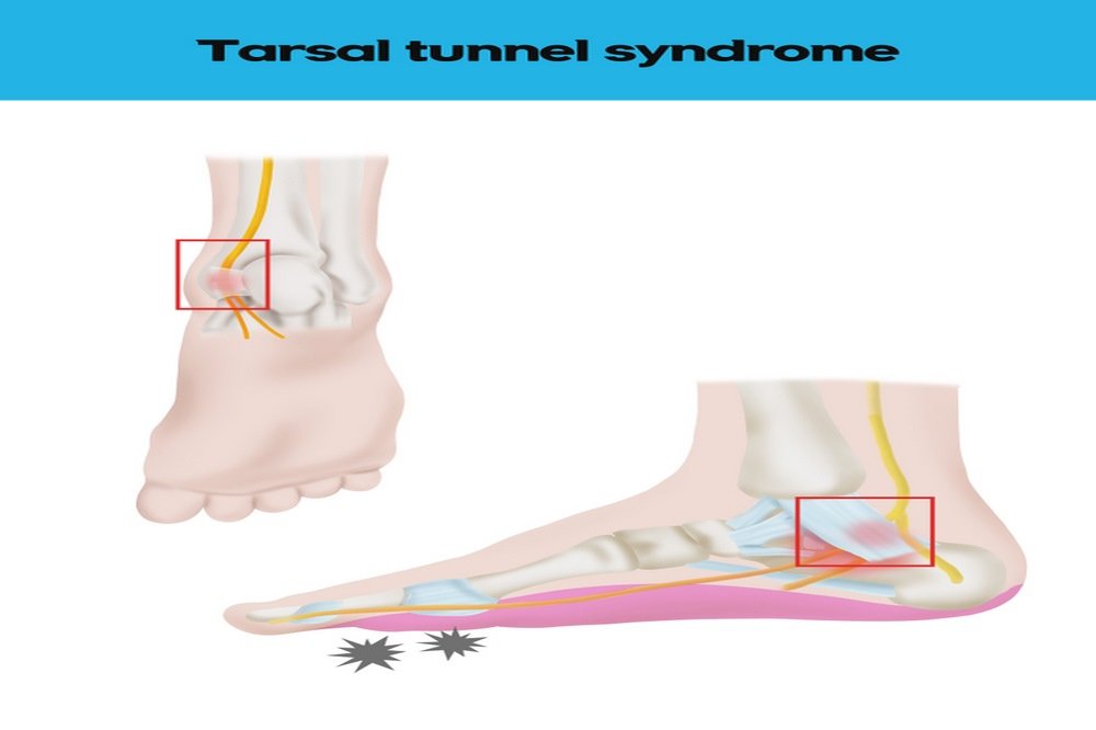 Tarsal tunnel syndrome