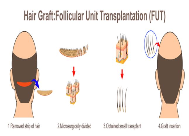Follicular unit transplantation (FUT)