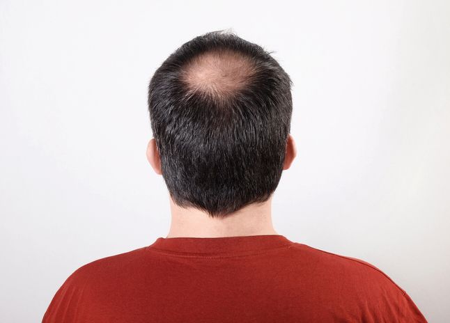 Patchy or round bald spots