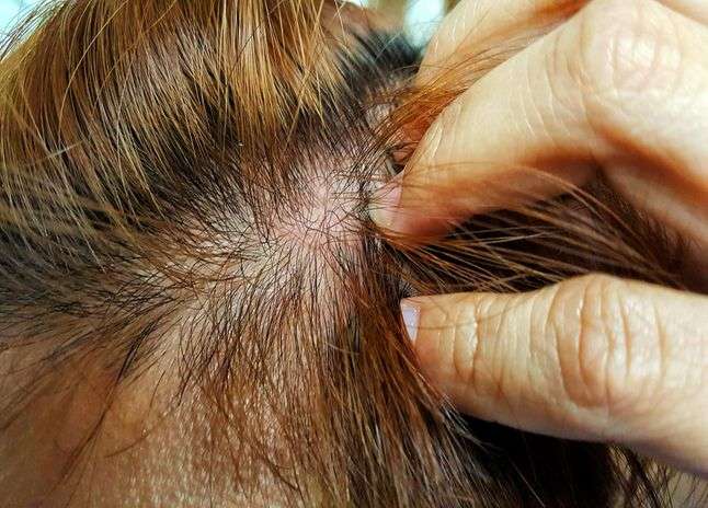 Scaling patches spreading over the scalp