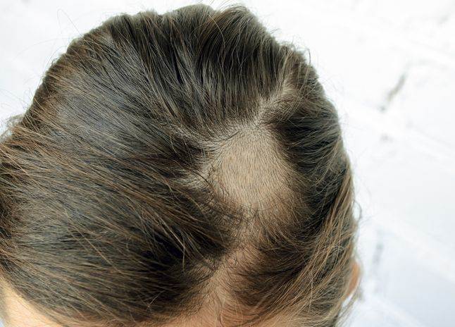 Scalp infection