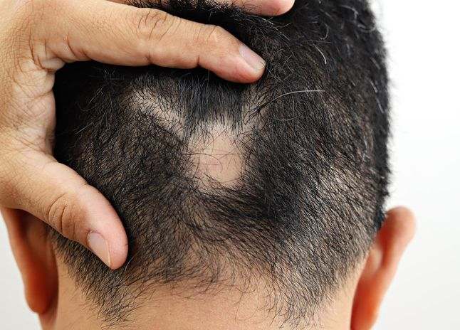 Top 18 Hair loss Causes
