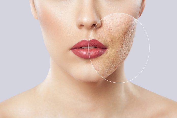 Cure acne scarring