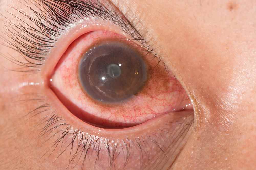 Eye inflammation (anterior uveitis)
