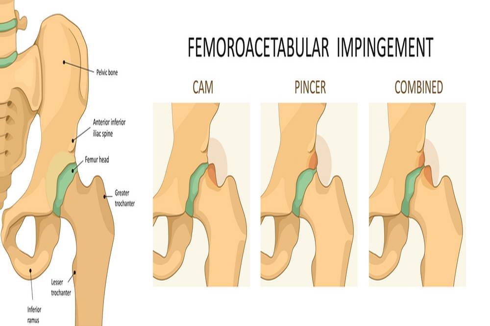 Femoroacetabular impingement (FAI)