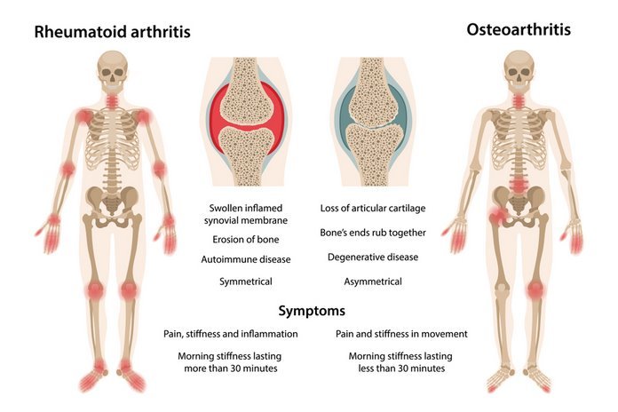 Osteoarthritis/ rheumatoid arthritis