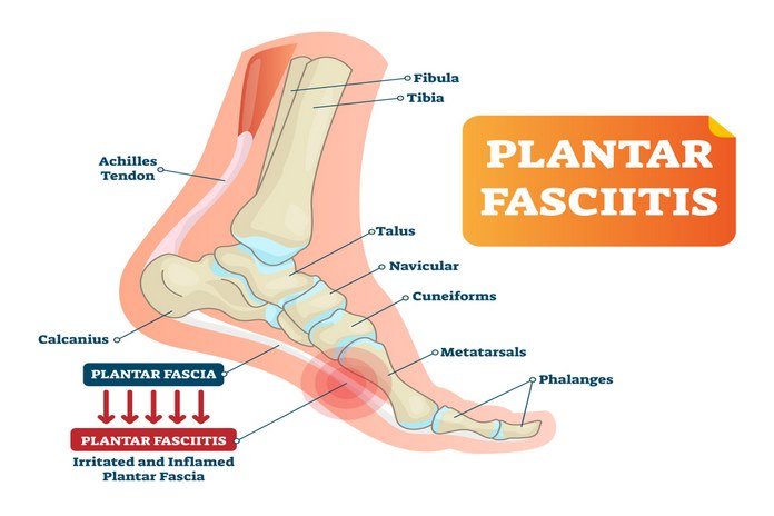 Plantar Fasciitis: Symptoms, Causes, Diagnosis, Home Remedies and Treatments