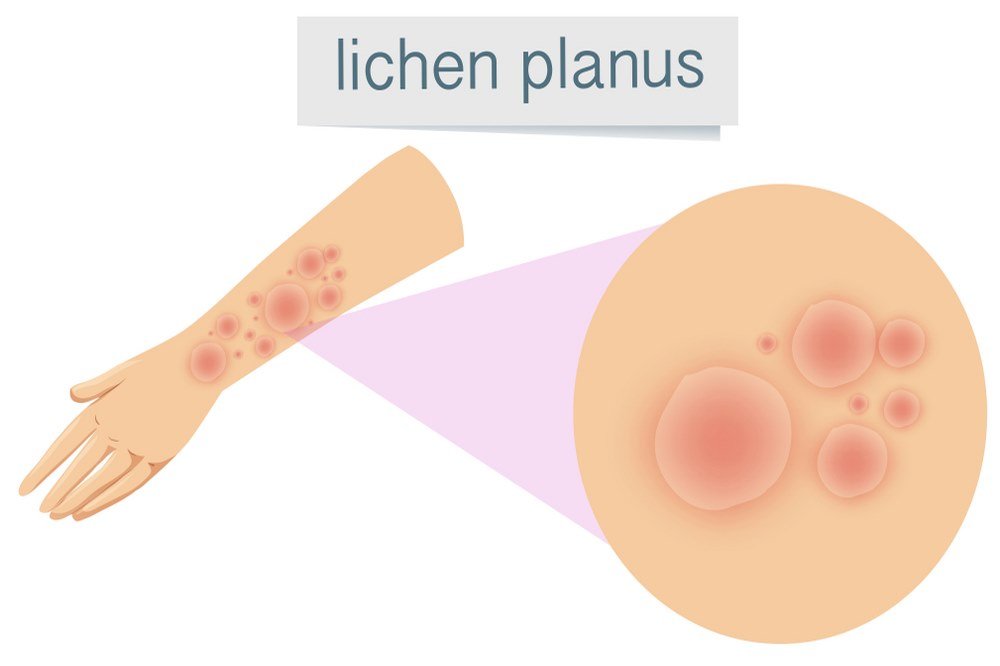 Skin rash (Lichen planus)