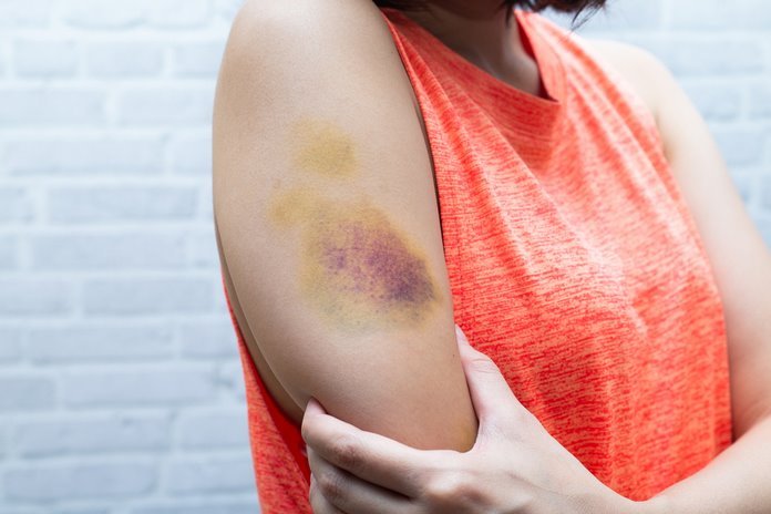 Unexplained bruises or bleeding