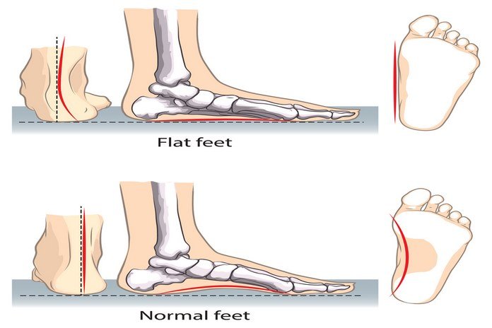 You have flat or high-arched feet