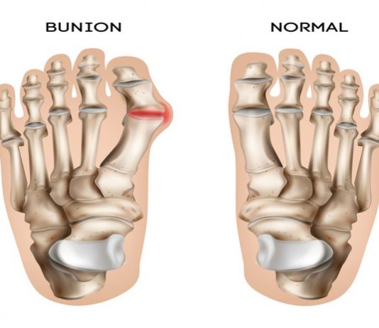 Bunions: What Causes Them, Types, Symptoms, Risk factors, Diagnosis, Treatment & Prevention