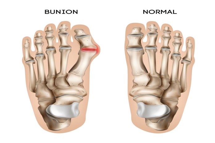 Bunions: What Causes Them, Types, Symptoms, Risk factors, Diagnosis, Treatment & Prevention
