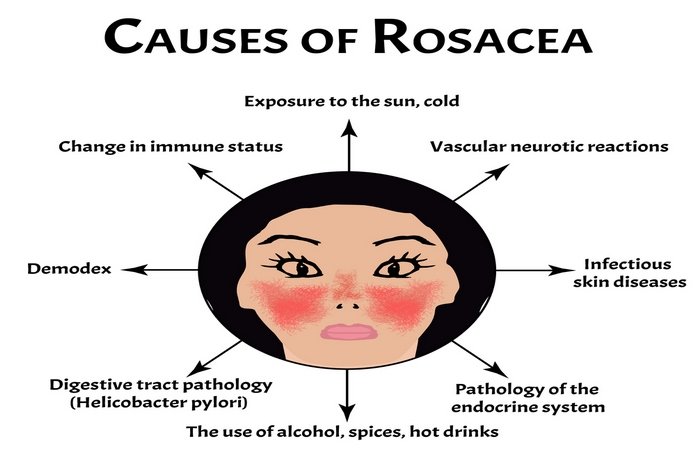 Rosacea Causes