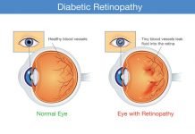 Diabetic Retinopathy: Symptoms, Causes, Types, Risk Factors, Diagnosis, Stages, Treatment and Prevention