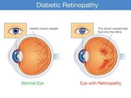 Diabetic Retinopathy: Symptoms, Causes, Types, Risk Factors, Diagnosis, Stages, Treatment and Prevention
