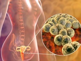 What Is Gonorrhea? Symptoms, Causes, Diagnosis, Treatment and Prevention