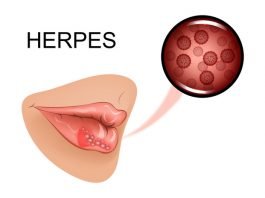 Herpes on all body parts such as (Lips, Mouth, Tongue, Buttocks, Hands)