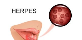 Herpes on all body parts such as (Lips, Mouth, Tongue, Buttocks, Hands)