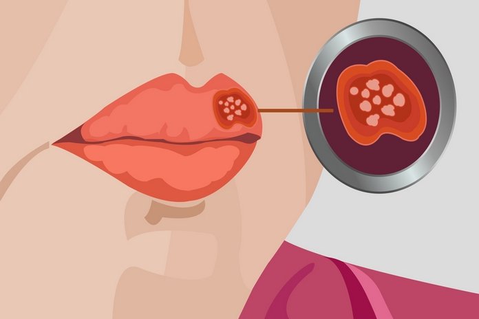 Herpes: Symptoms, Causes, Treatment, and Prevention