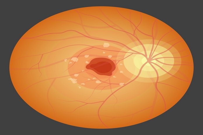 Neovascular glaucoma