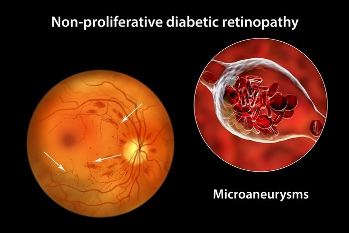 Nonproliferative Diabetic Retinopathy