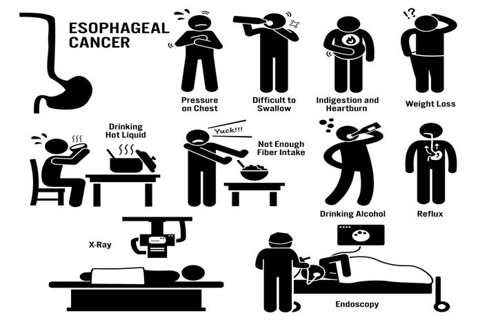 Esophageal Cancer Prevention