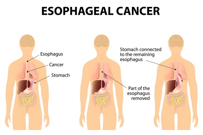 Esophageal Cancer Prognosis
