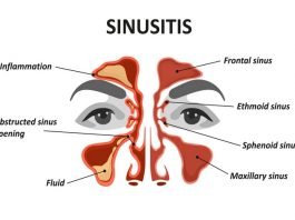 Sinus Infection (Sinusitis): Types, Causes, Symptoms, Risk Factors, Complications, Diagnosis and Treatment