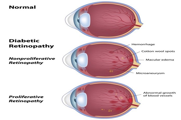 Major Stages Of Diabetic Retinopathy