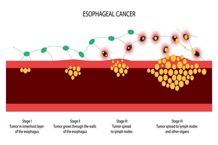 Esophageal Cancer Stages
