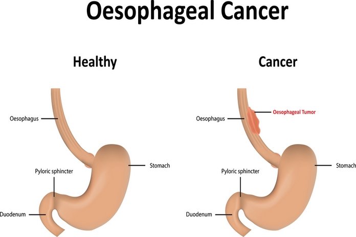 Esophageal Cancer Survival Rate