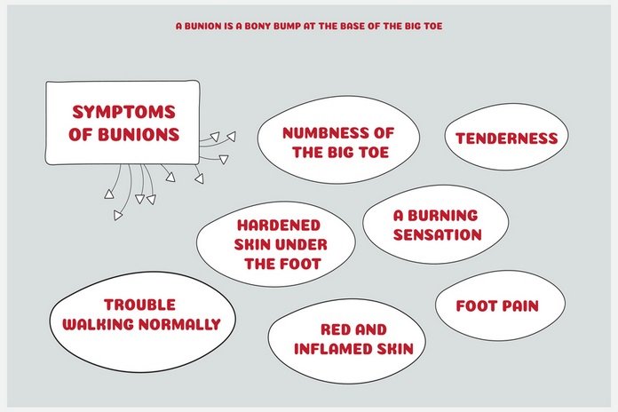 Bunions Symptoms