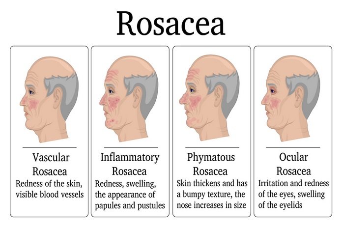 Rosacea Types