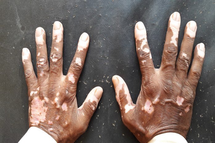 Vitiligo: Types, Symptoms, Causes, Treatment & Recovery