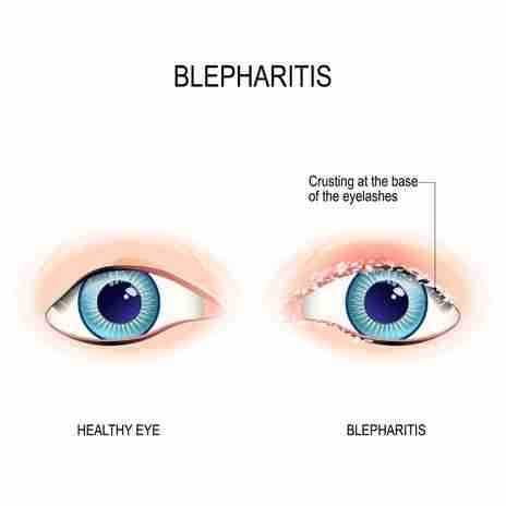 What Is Blepharitis (Eyelid Inflammation)? Symptoms, Causes, Risk Factors, Diagnosis, Home Remedies, Treatment, Complications, Prevention