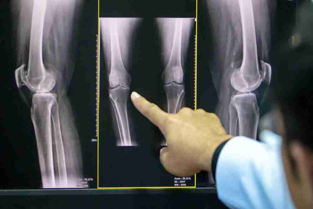 How Osteoarthritis Is Diagnosed?