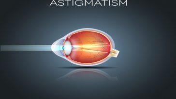 What Is Astigmatism? Symptoms, Causes, Diagnosis, Treatment