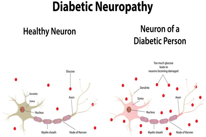 Beneficial In Diabetic Neuropathy