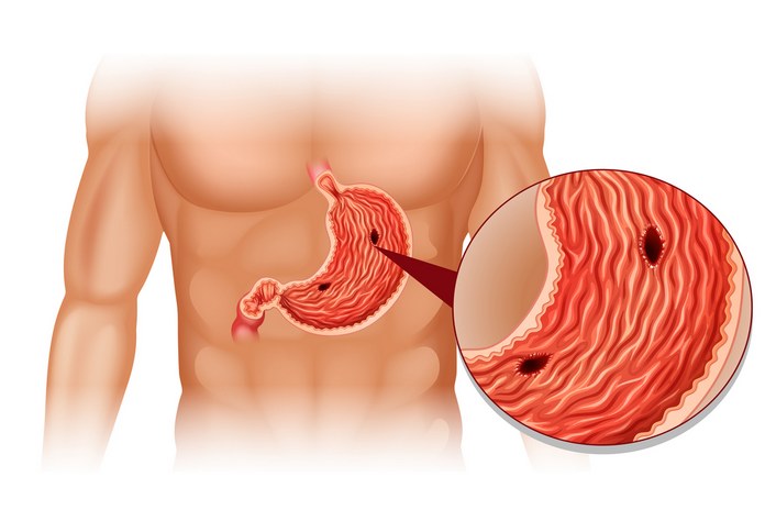 Cure Stomach Ulcers