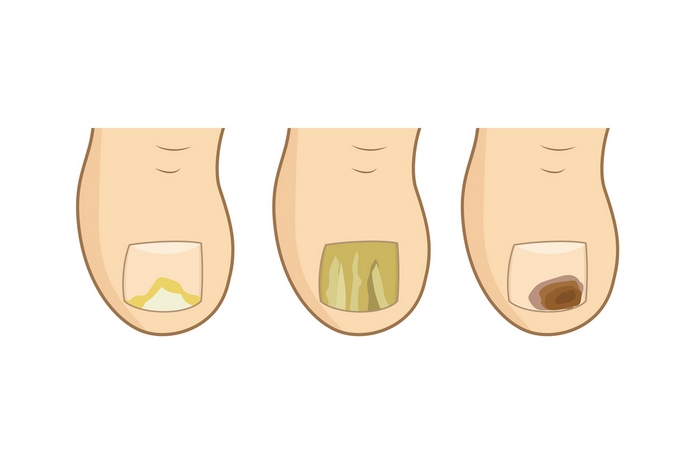 Toenail Fungus Stages
