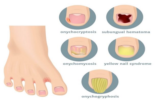 Toenail Fungus Guidelines Page 3 Of 11 Betahealthy