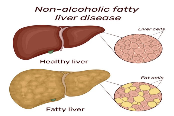 Treat Nonalcoholic Fatty Liver Disease