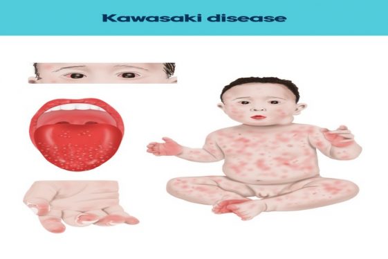 Kawasaki Disease: Symptoms, Causes, Diagnosis & Treatment - Betahealthy