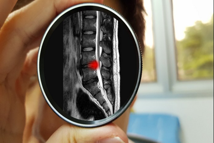 Spinal Stenosis Diagnosis
