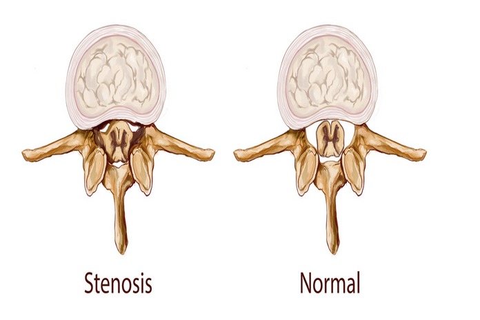 Spinal Stenosis Pathophysiology