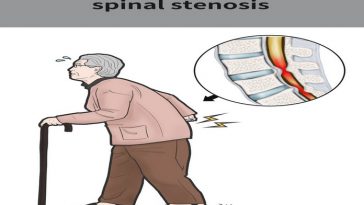 Spinal Stenosis Symptoms